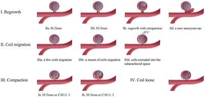 Surgical Clipping of Previously Coiled Recurrent Intracranial Aneurysms: A Single-Center Experience